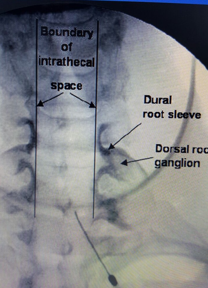 cervical epidural (2).jpeg